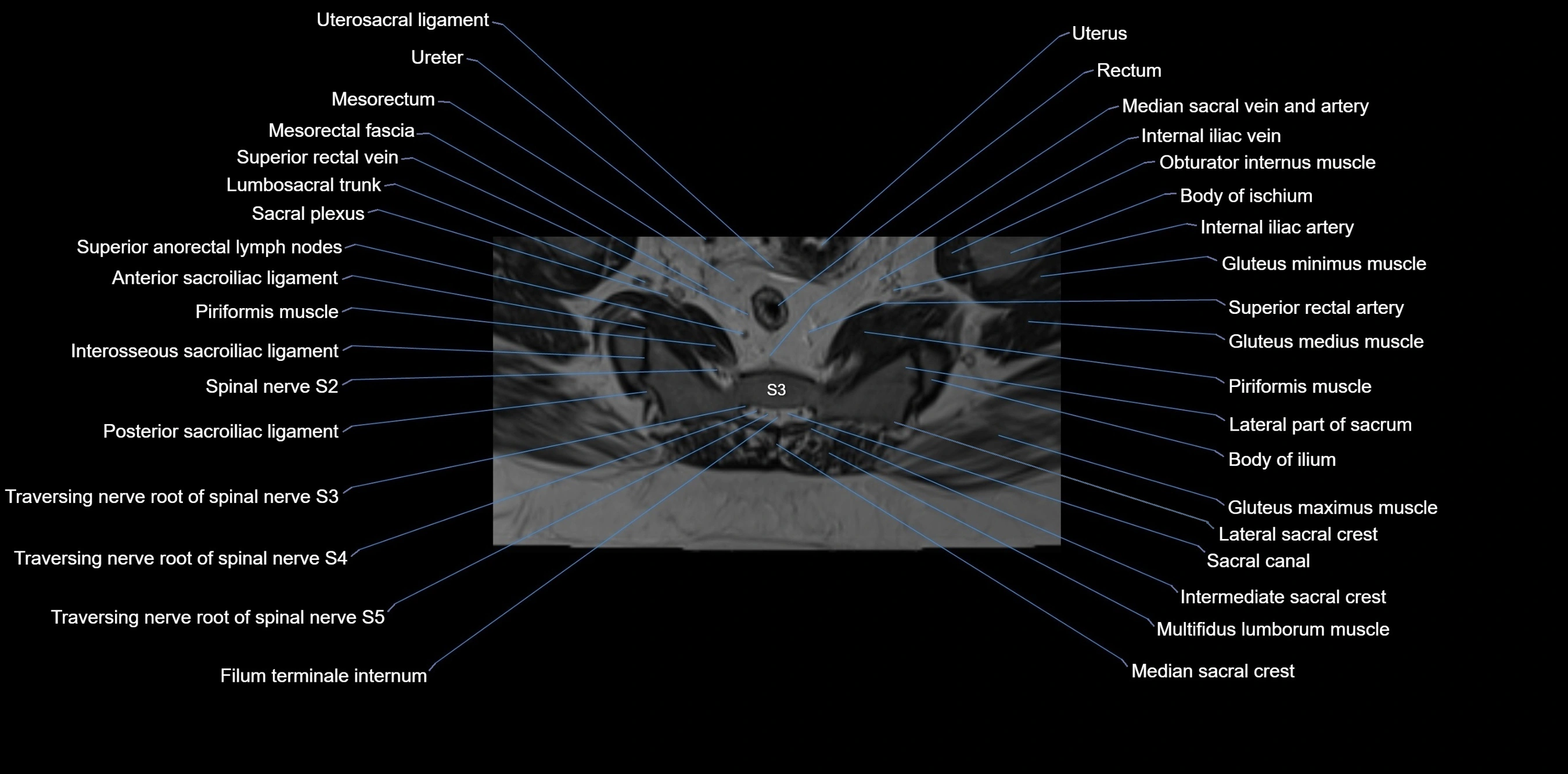 MRI sacrum, coccyx and sacroiliac joint axial cross sectional anatomy 3T  radiology  image-img-00001-00036.webp